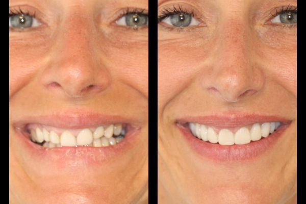 Facettes céramiques et gingivectomie laser